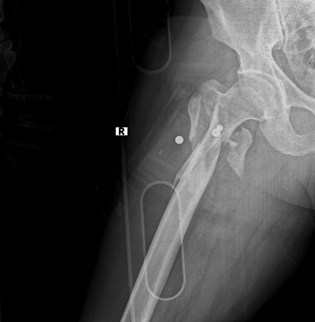 Pelvis kırığı röntgeni