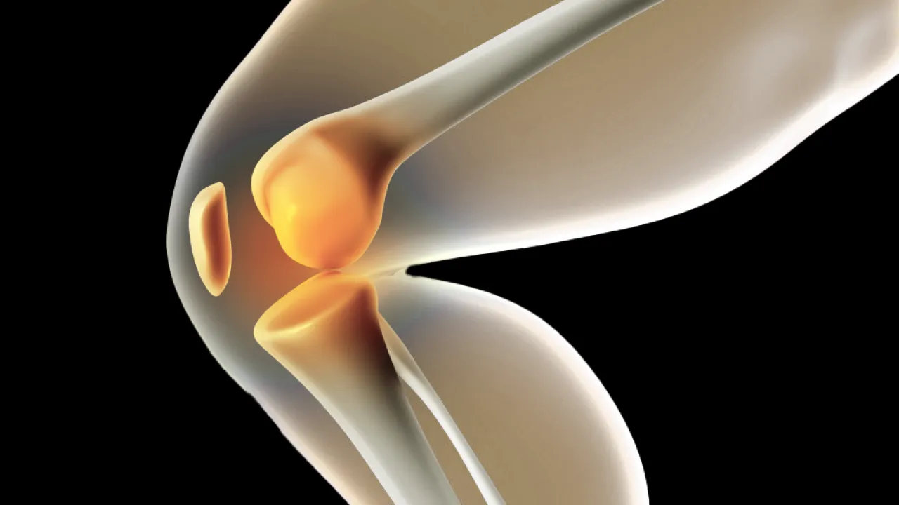 Diz Kıkırdak Hasarı ve Kireçlenme Tedavileri