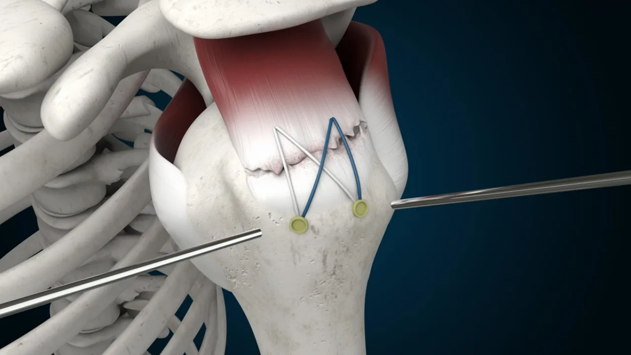 Omuz Kas Yırtığı (Rotator Cuff) ve Ameliyatı