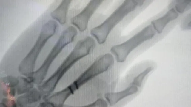 El Cerrahisi ve Mikrocerrahi: İş Kazalarında Acil Çözümler