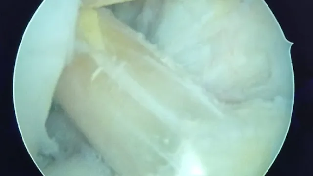 Menisküs ve Ön Çapraz Bağ Yaralanmaları