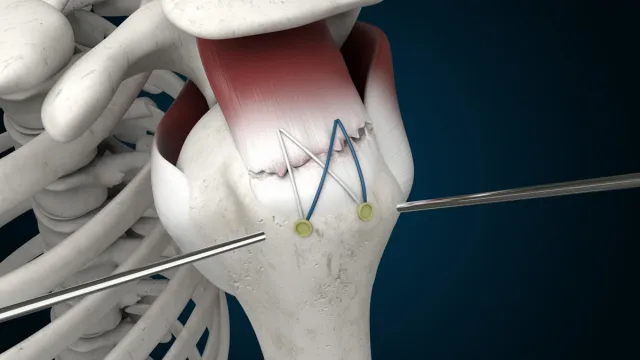 Omuz Kas Yırtığı (Rotator Cuff) ve Ameliyatı
